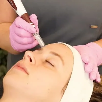 Microneedling op het voorhoofd